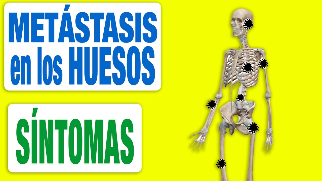Todos los Síntomas de las Metástasis en los Huesos