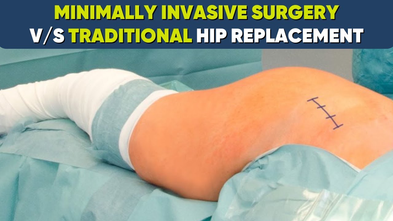Total Hip Replacement: MIS vs. Conventional Surgery -AVN Warrior's Guide
