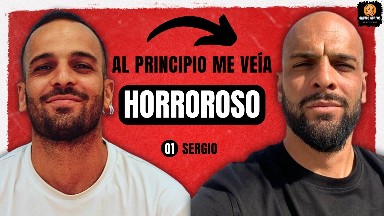 Me quedé CALVO A LOS 20'S así que me RAPÉ LA CABEZA - CALVOS GUAPOS 01 - SERGIO