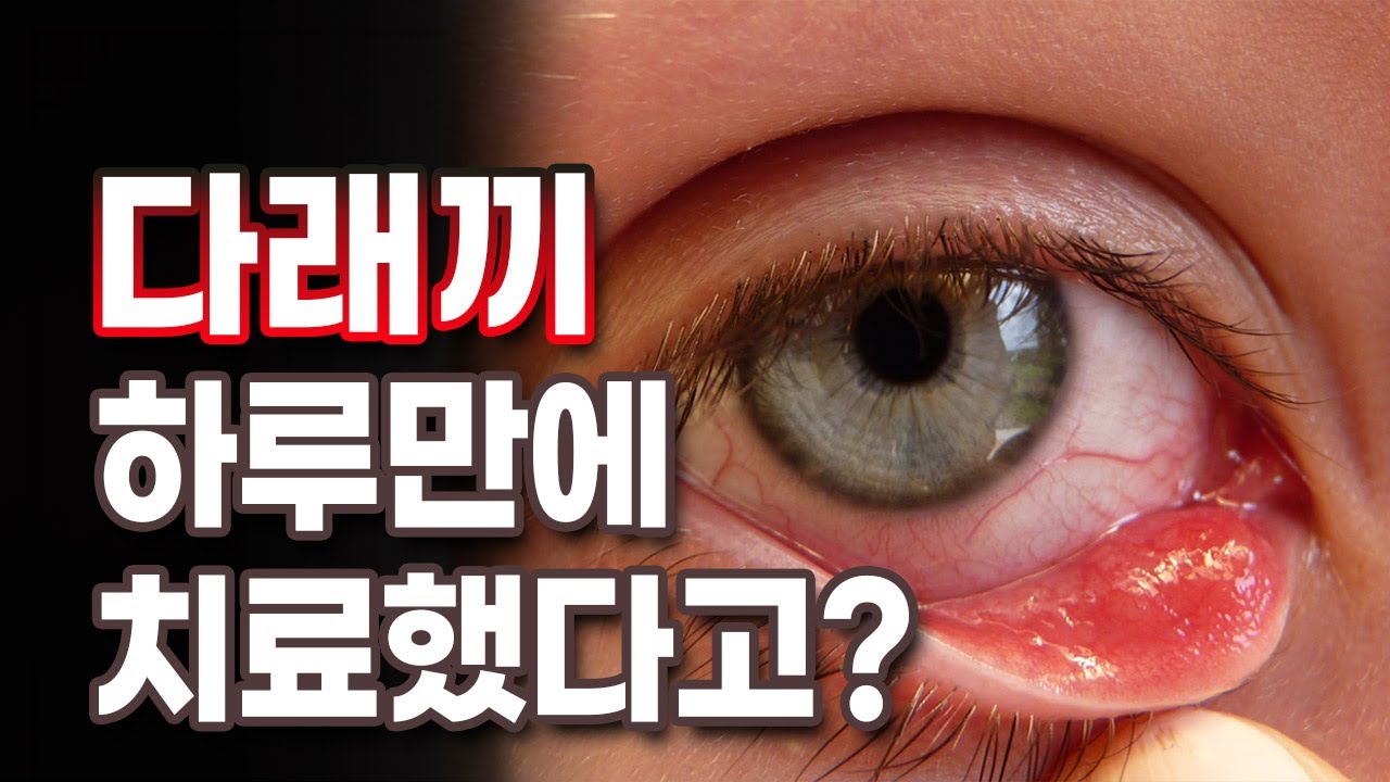 다래끼 빨리 낫는 법 공개합니다 대체 어떤 방법일까요｜노기환 원장