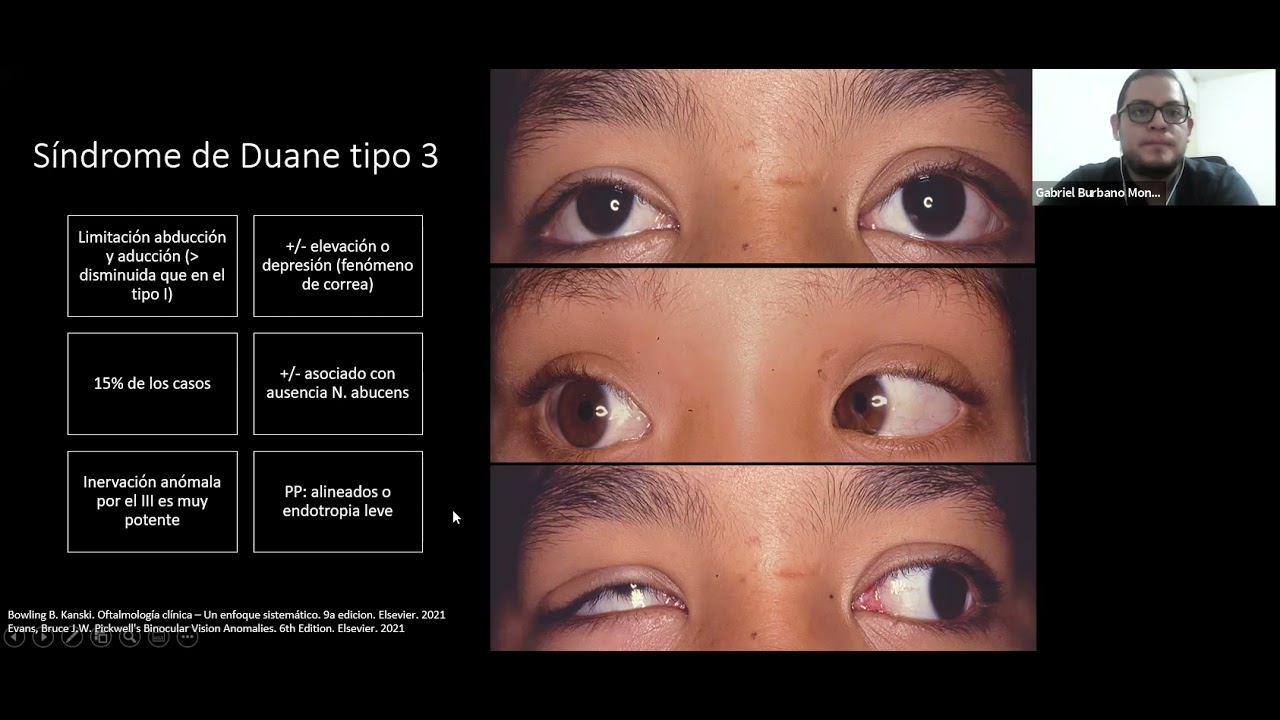 Sindrome de Duane, Brown y Moebius Dr. Gabriel Burbano