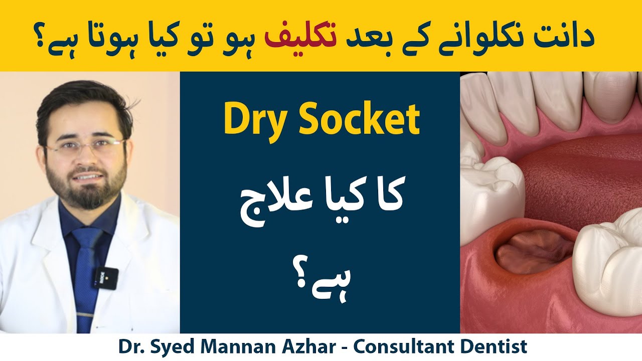 What Are The Causes Of Dry Socket? (Urdu/Hindi) | Daant Nikalwany Ke Baad Dry Socket Q Hojati Hy?
