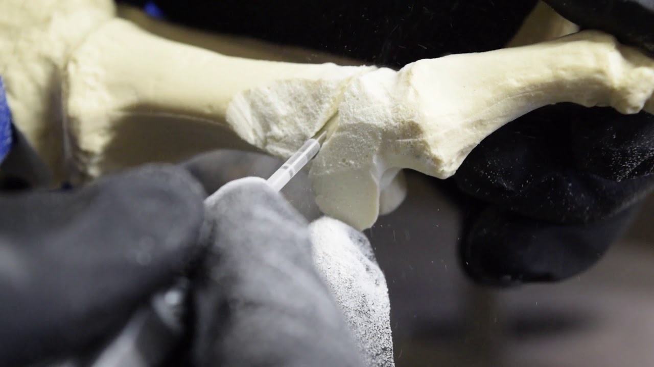MINIMALLY INVASIVE CORRECTION OF ARTHRITIS OF 1ST BIG TOE JOINT