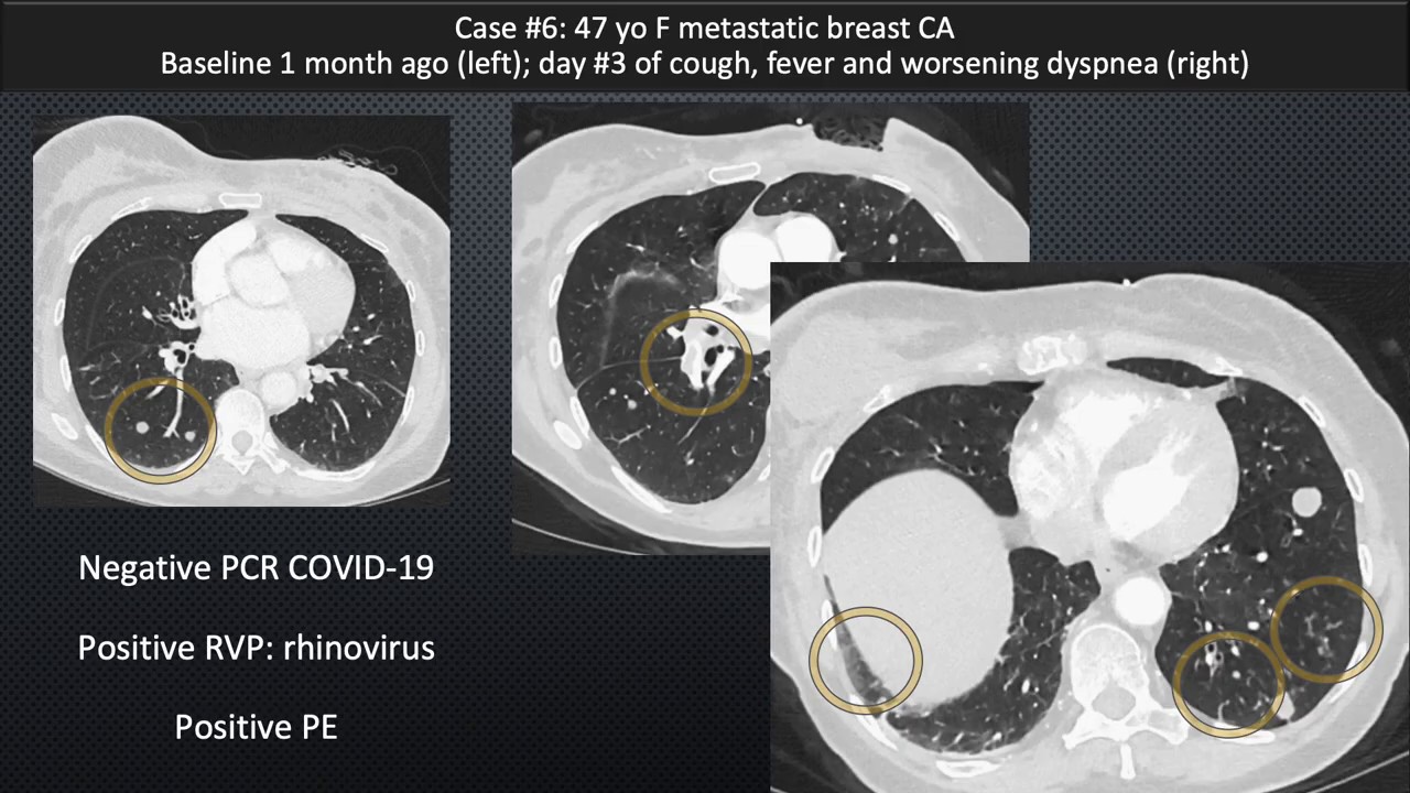 Pt. 1 Chest CT Appearance of COVID-19