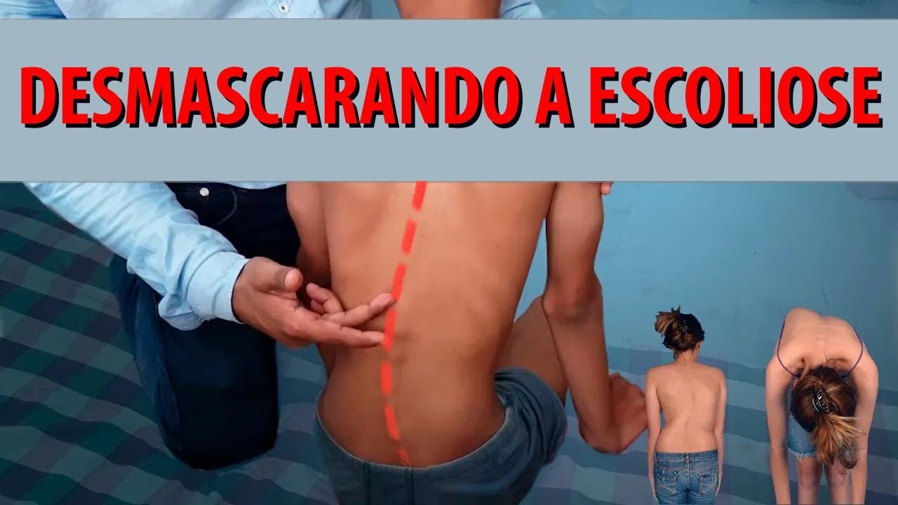 O que é escoliose?