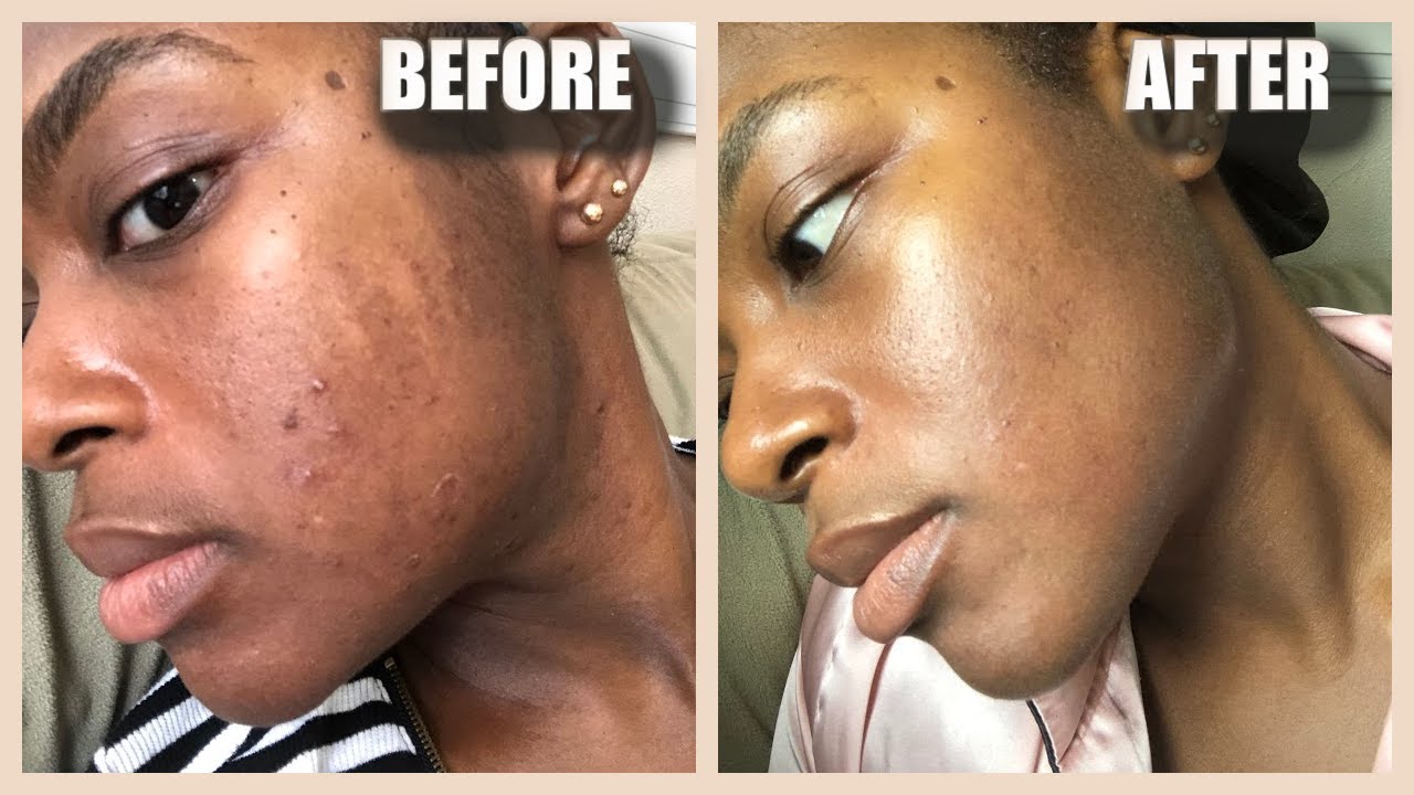 MASKNE |  HOW I CLEARED MY MASK ACNE FAST | Tips to Prevent Maskne | SUPPLEMENTS for Acne Prone Skin