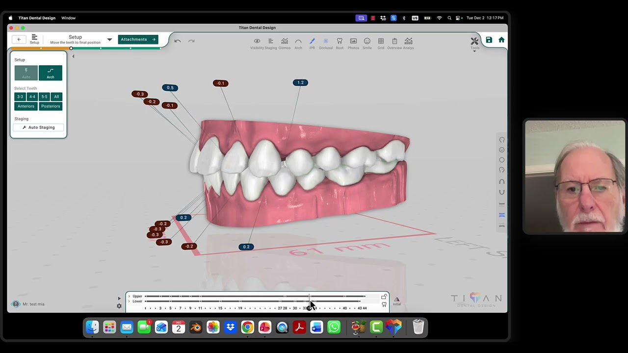 sequential aligners staging  inital concept.
