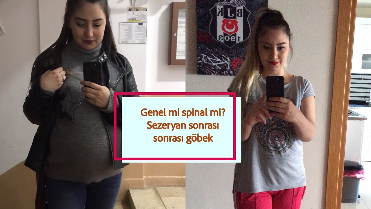 GENEL Mİ SPİNAL ANESTEZİ Mİ? SEZERYAN SONRASI GÖBEK..