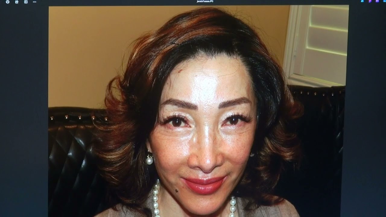 Stunning Female Hairline Result After 1 Year | Natural Density & Face Framing