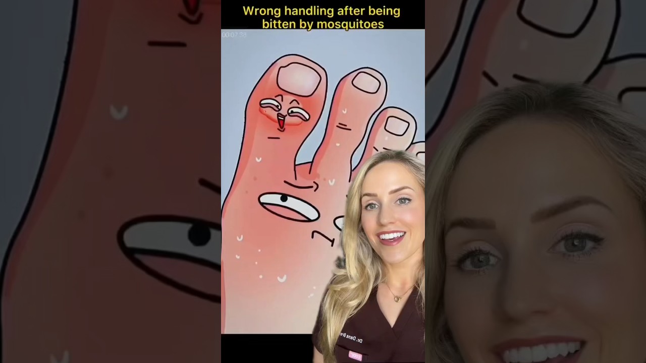 Doctor explains how to treat mosquito bites!