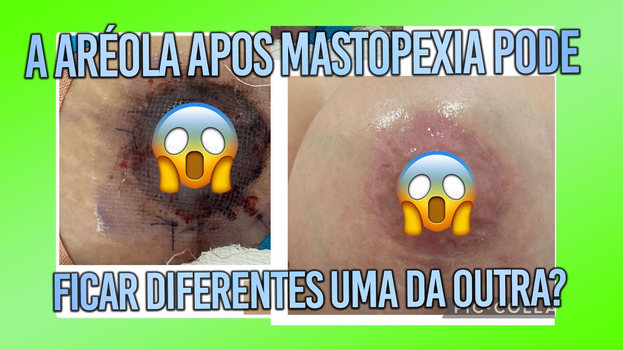 A ARÉOLA APÓS A MASTOPEXIA PODE FICAR DIFERENTES UMA DA OUTRA? É NORMAL? – CIRURGIA PLÁSTICA