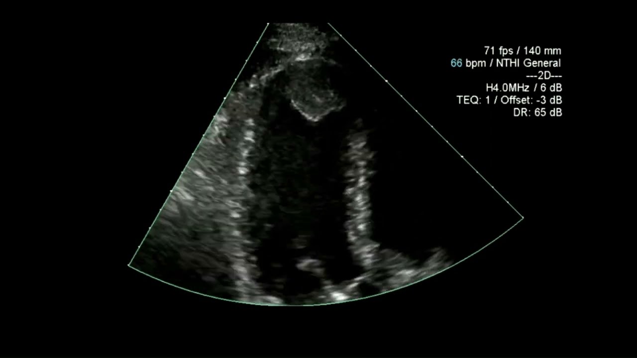 Apical Mural Thrombus Cases