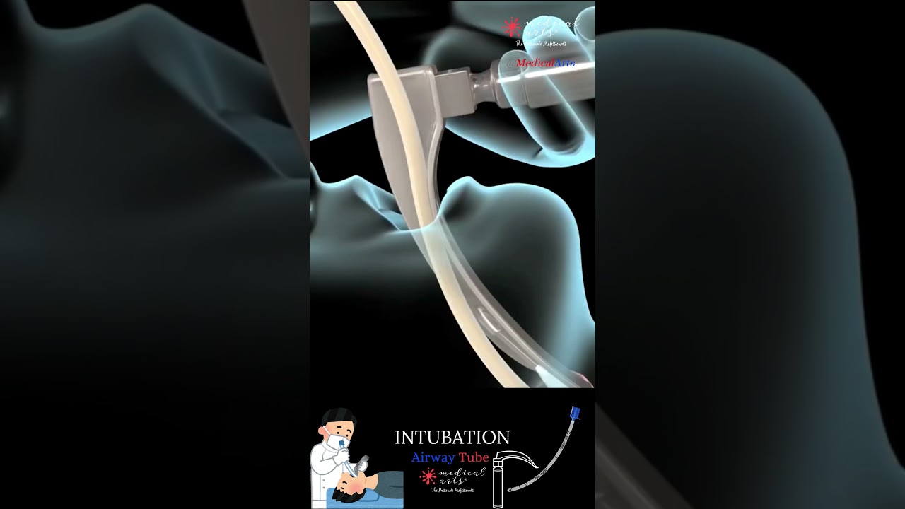 Intubation - EndoTracheal Tube - Breathing Tube #medicalanimation