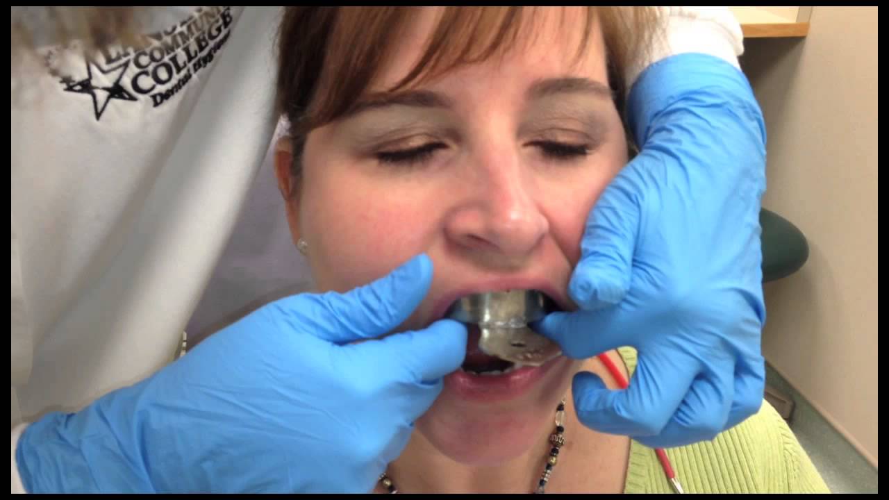 Taking a Lower Alginate Impression