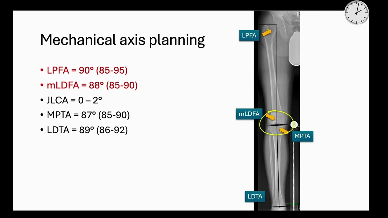 MAP the ABC for frontal Plane Deformity ( FRCS Trauma and Orthopaedic Exam)