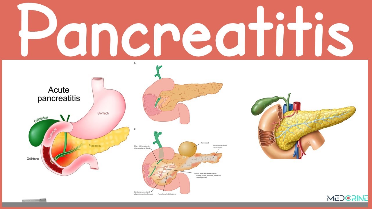 Acute and Chronic Pancreatitis: Pathophysiology, Presentation, Diagnosis and Management Made easy
