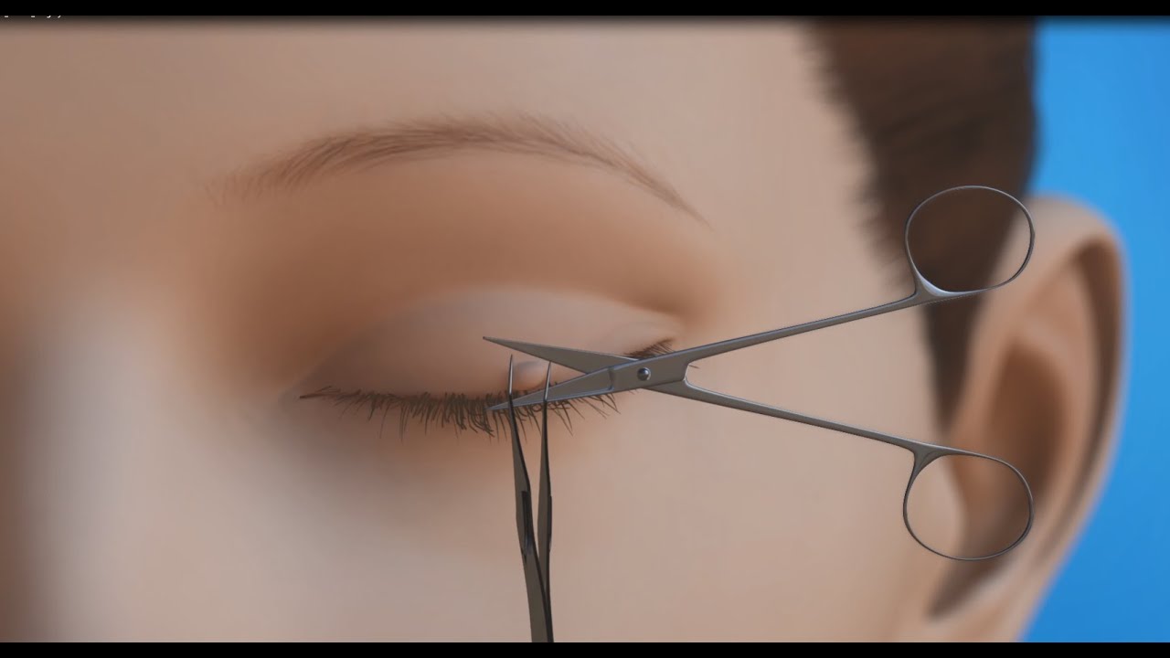 Oculoplastics Eyelid Lesion Surgery