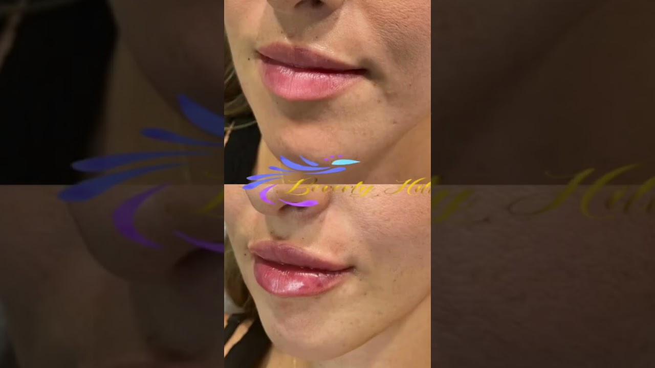 Lip FILLER Before and After What to Expect in 2024 at Beverly Hills Wellness Center & Med Spa, Fl