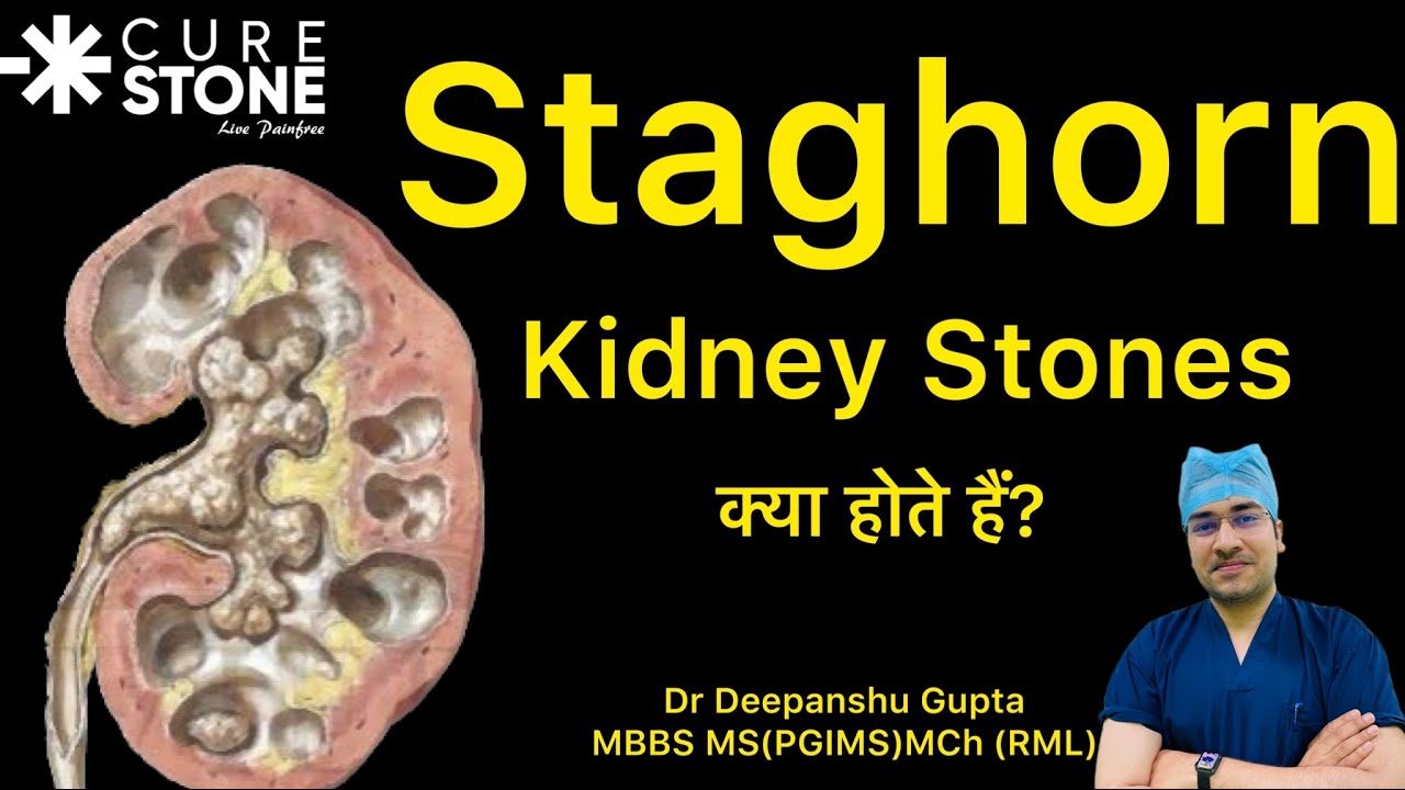 Staghorn Kidney stones क्या होते हैं? | Kidney stones treatment | PCNL |RIRS | Dr Deepanshu Gupta