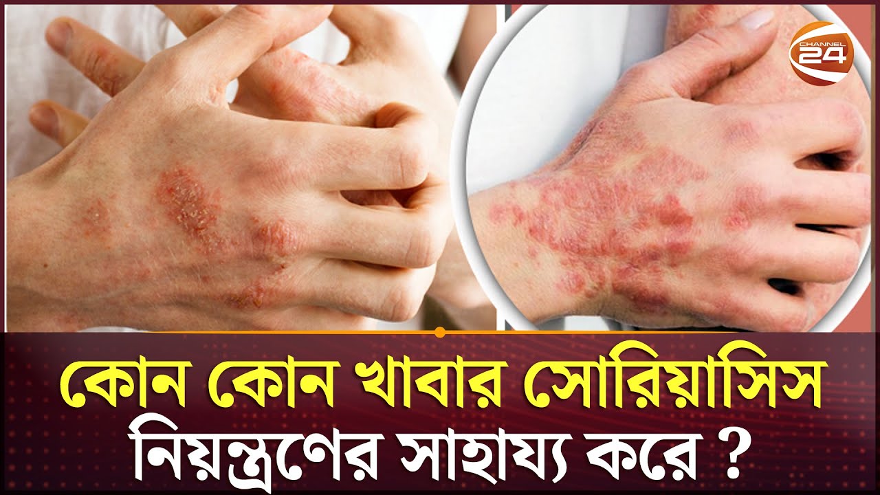 সোরিয়াসিস নিয়ন্ত্রণ করবেন কিভাবে ? জানুন  | Psoriasis | Skin care | Health Care | Channel 24