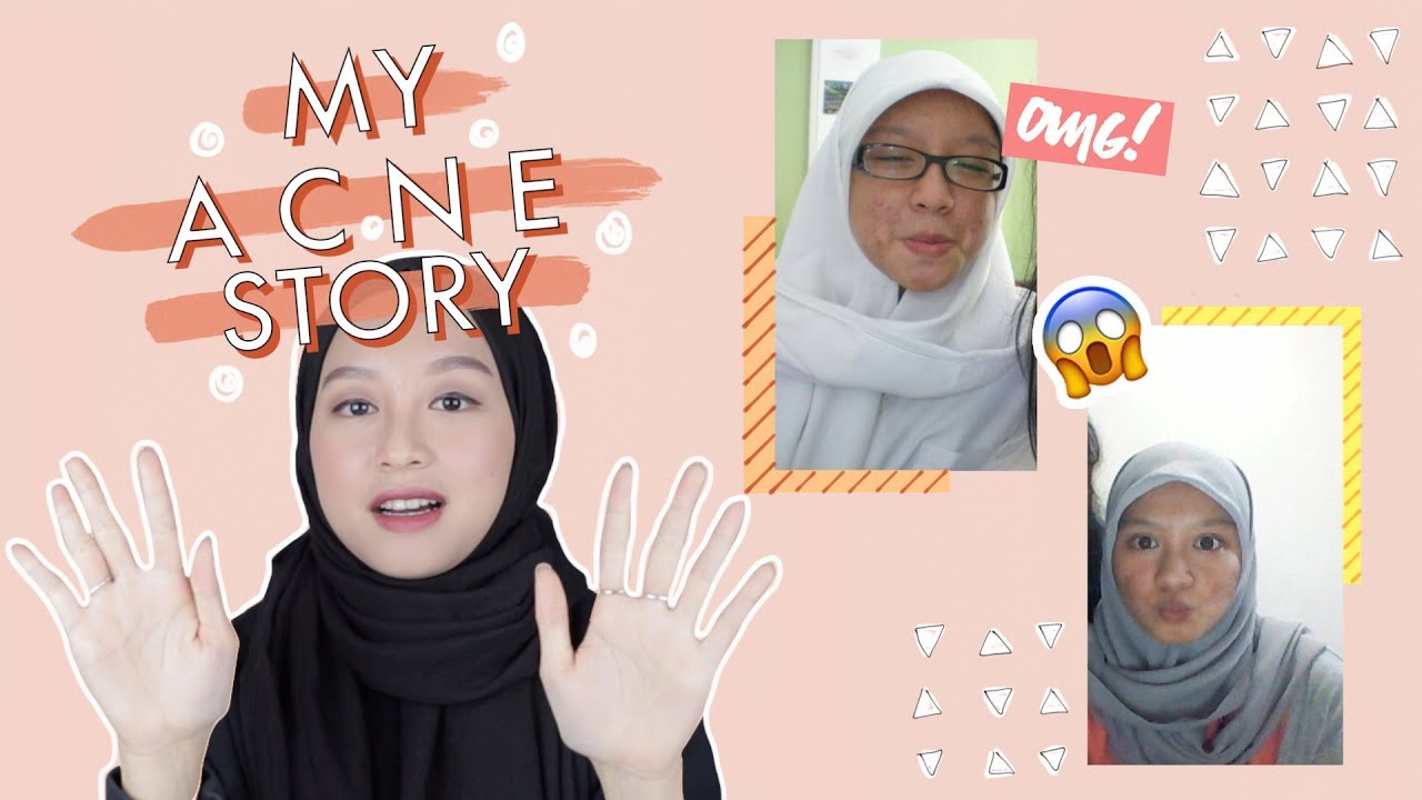 Why I stopped photoshopping my face | Acne story