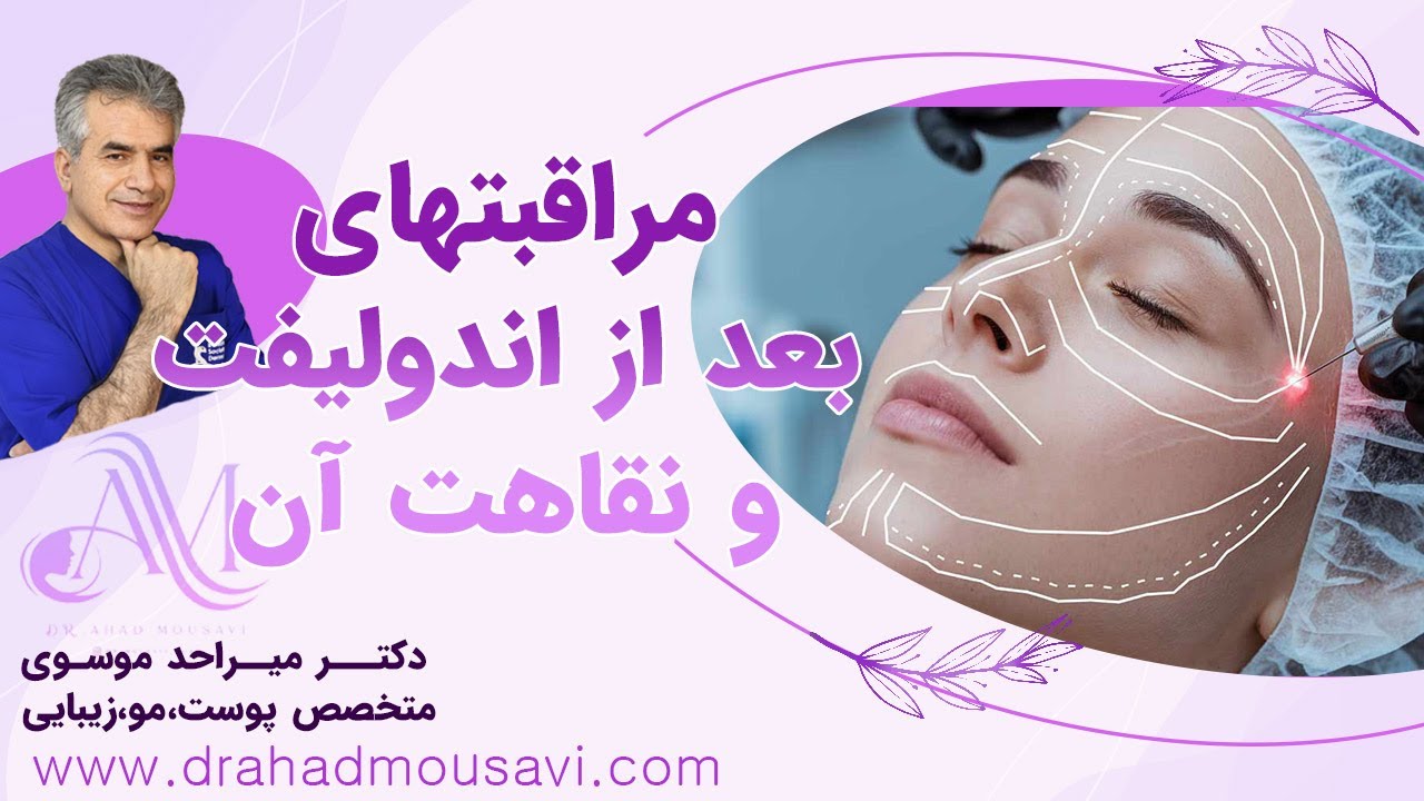 مراقبت‌های طلایی بعد از اندولیفت: نکاتی که بعد از اندولیفت پوستت رو نجات می‌ده!