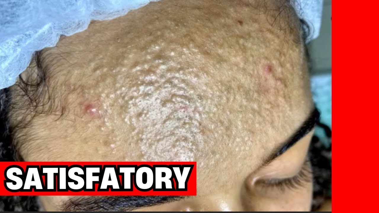 EXTRA&Ccedil;&Atilde;O DE CRAVOS SATISFAT&Oacute;RIA | LIMPEZA DE PELE COMENTADA POR ESTETICISTA! #356476