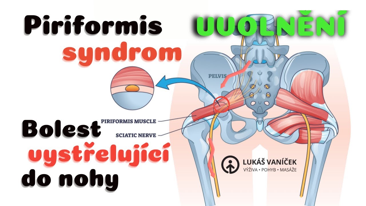 Uvolnění sedacího nervu a SI skloubení - Piriformis syndrom - bolest vystřelující do nohy