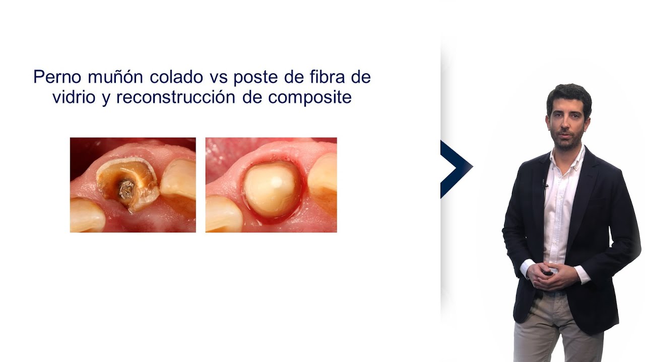Diferencias e indicaciones de perno-mu&ntilde;&oacute;n colado y poste de fibra de vidrio