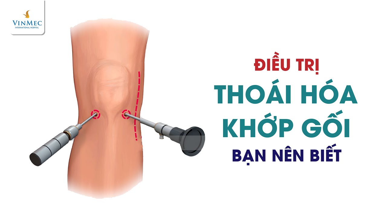 Điều trị thoái hóa khớp gối đúng cách