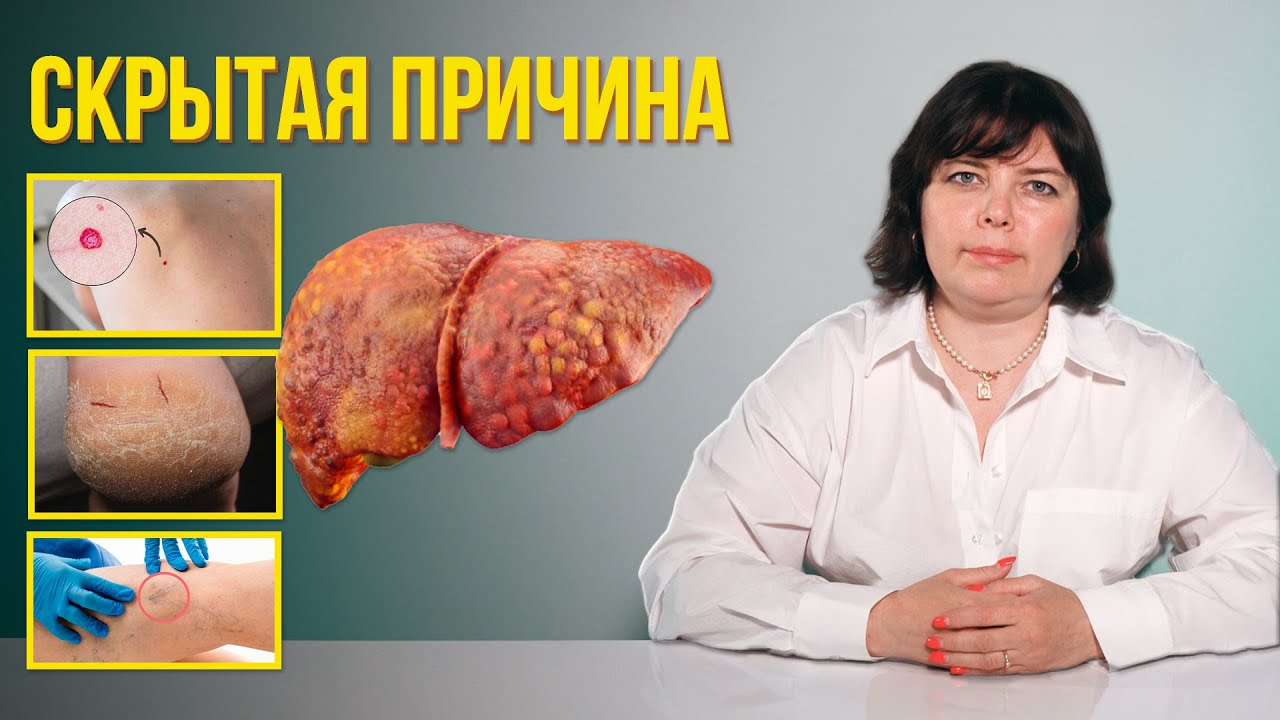 ❗️Желтуха, трещины на пятках, красные пятна - всего лишь симптомы, она не болит до последнего