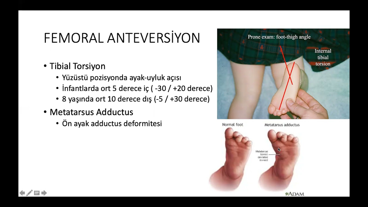 Çocuklarda ayak içe basma şikayeti (femoral anteversiyon sorunları)