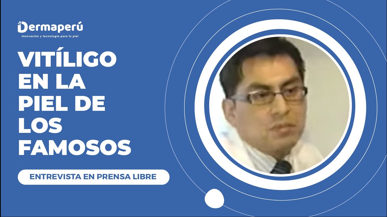 VITÍLIGO en la piel de los famosos - Entrevista en Prensa Libre