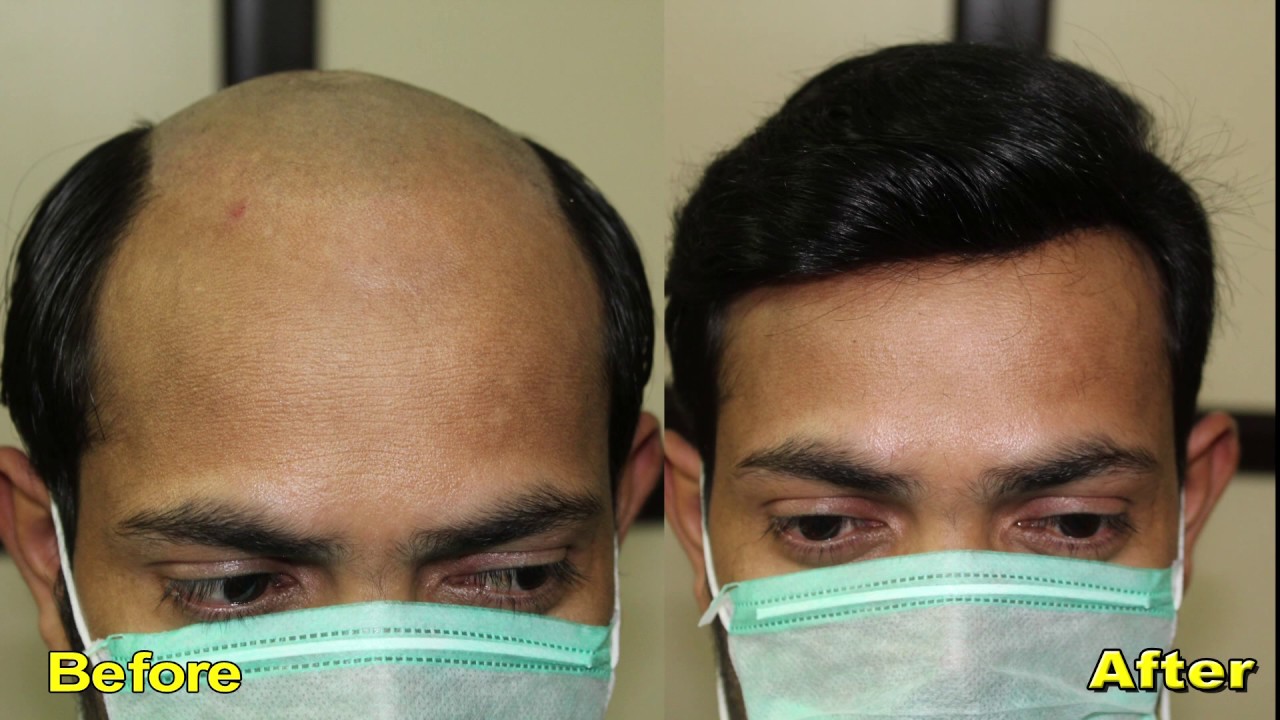 Hair Replacement in Hyderabad 9951223066