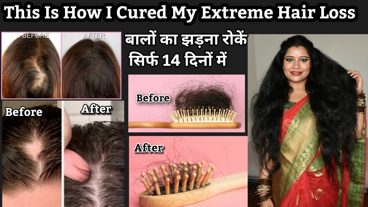 This is how I Cured my Extreme Hair Loss,Reasons Of Extreme Hair Loss and Hair Mask To StopHair Loss