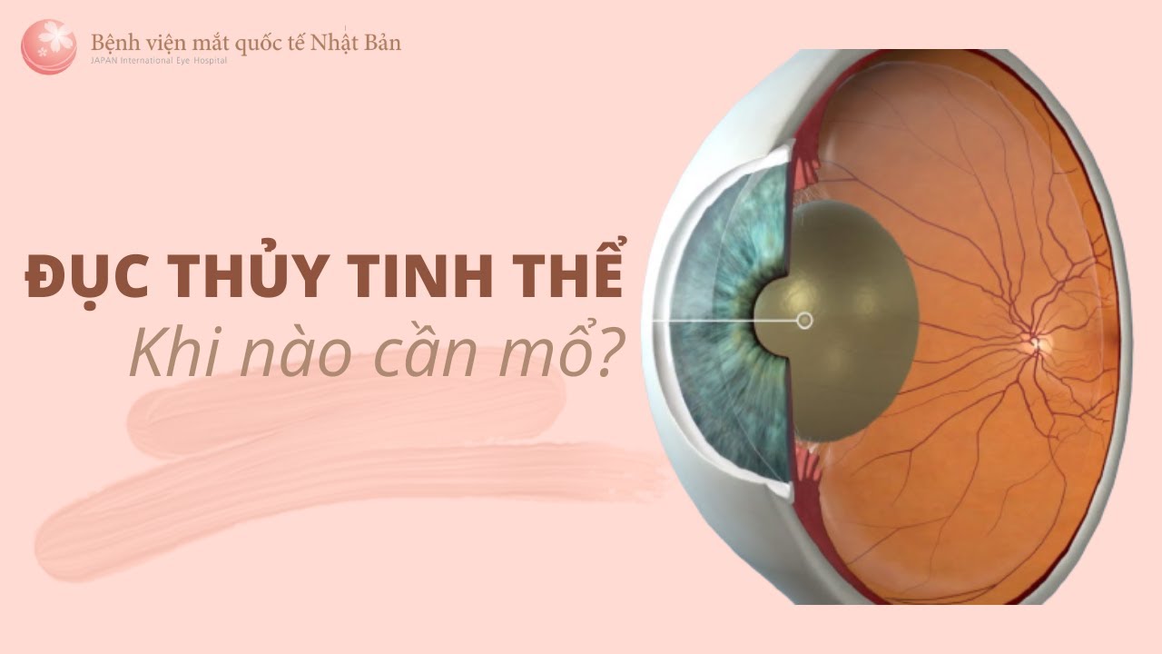 ĐỤC THỦY TINH THỂ, khi nào cần mổ? | Bệnh viện mắt quốc tế Nhật Bản 32 Phó Đức Chính
