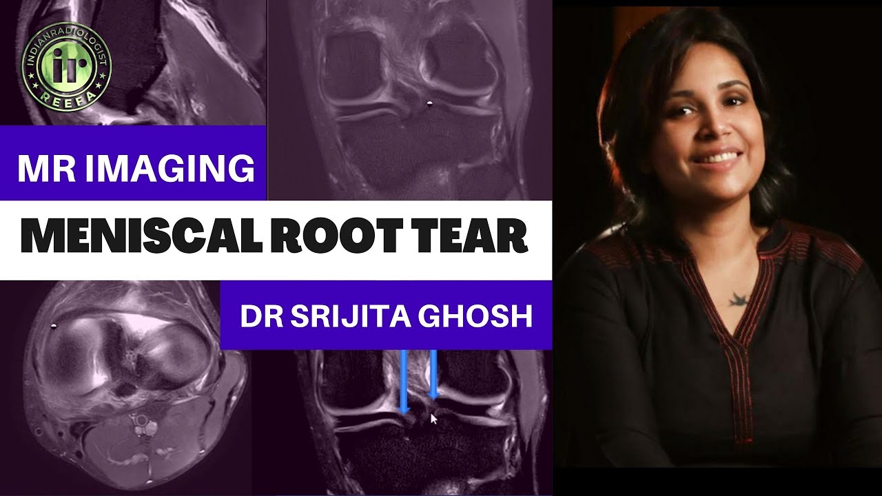 MENISCAL ROOT TEAR | SRIJITA GHOSH | MRI KNEE | MENISCAL TEARS | ROOT AVULSION | KNEE TRAUMA