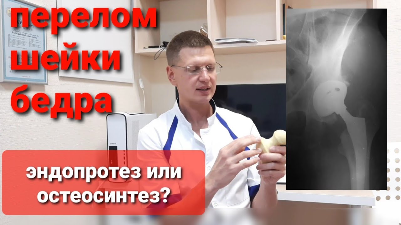 Как лечить перелом шейки бедра: эндопротезирование, остеосинтез. Почему перелом не срастается?