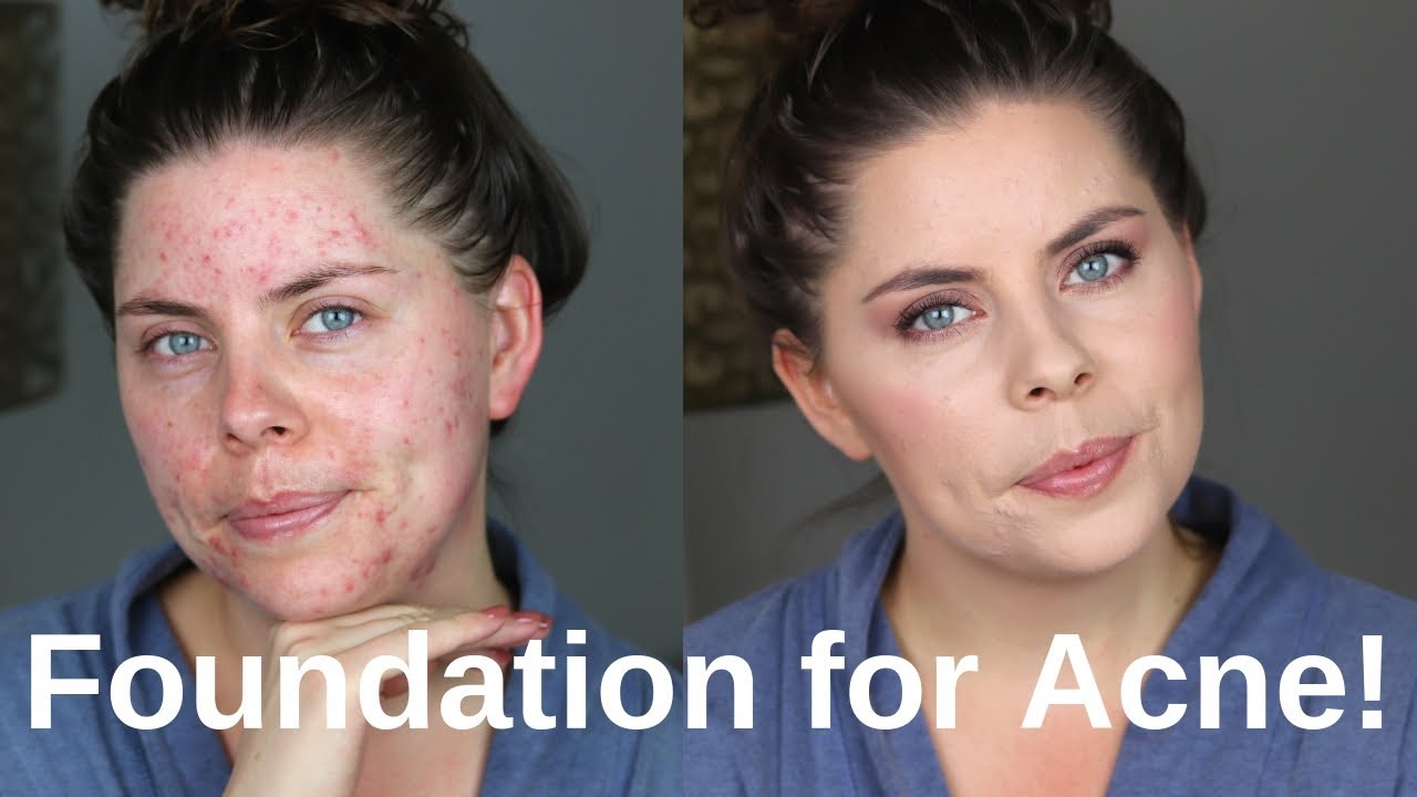 full coverage foundation tutorial for acne