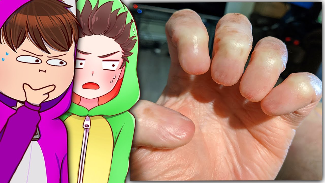 Ein Mann ohne Fingernägel! - Reddit