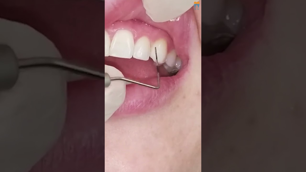 Mastering the Periodontal Probe Like a Pro! 🦷 #shorts #dental #health #trending
