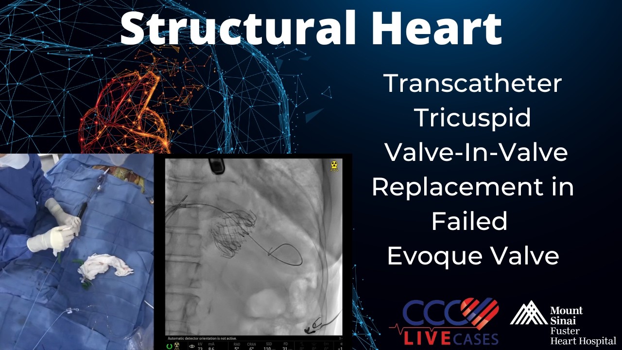 Transcatheter Tricuspid Valve-In-Valve Replacement in Failed Evoque Valve