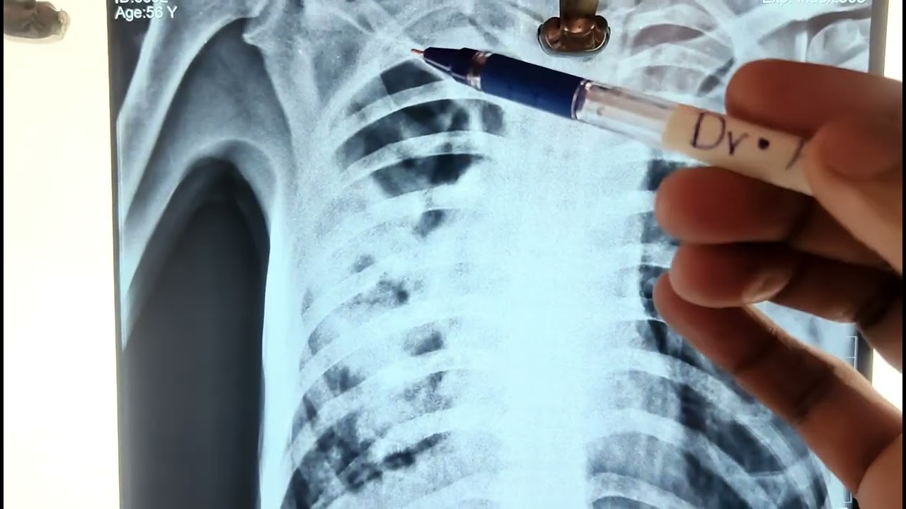 # X ray reading # cavitation in pulmonary TB# emergency medicine 