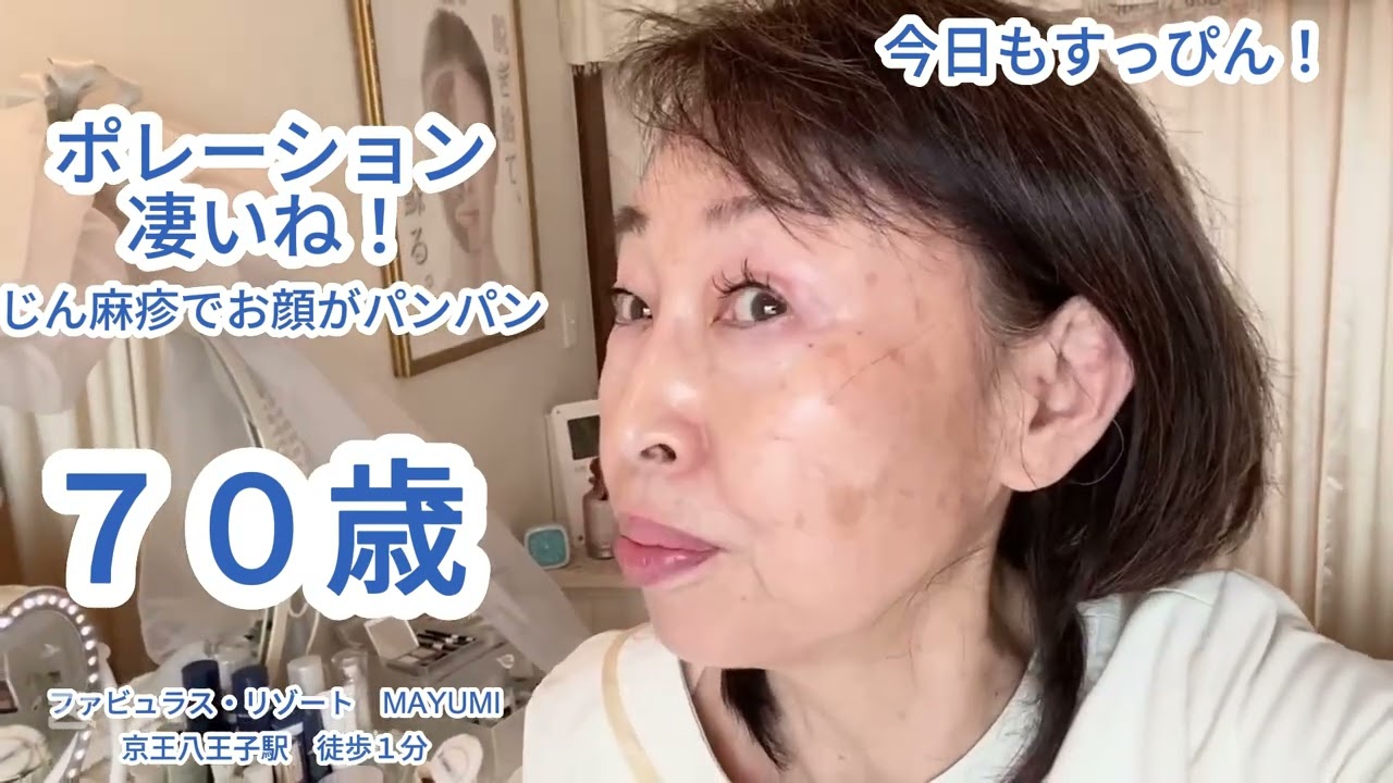 【70代シニア女性 Vlog】緊急事態！じん麻疹でお顔がパンパン！【八王子エステ／シミ・シワ・たるみ専門】