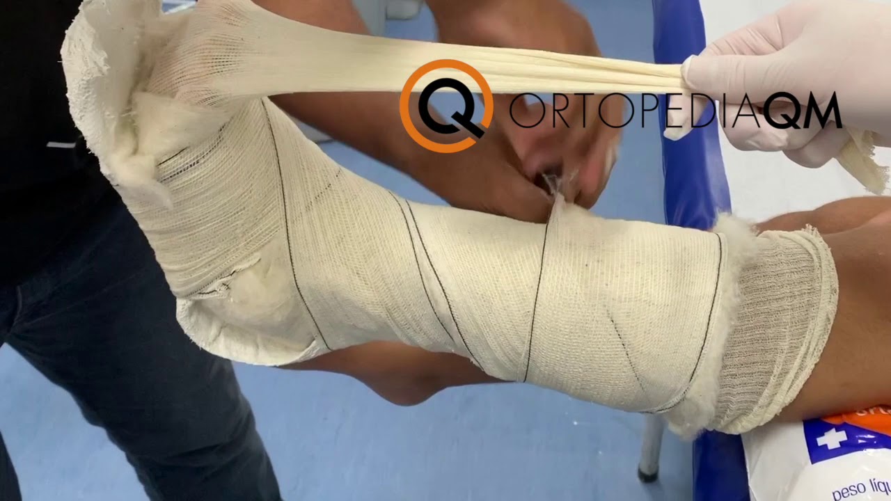 Tala Gessada Suropodálica (Bota), Como fazer?