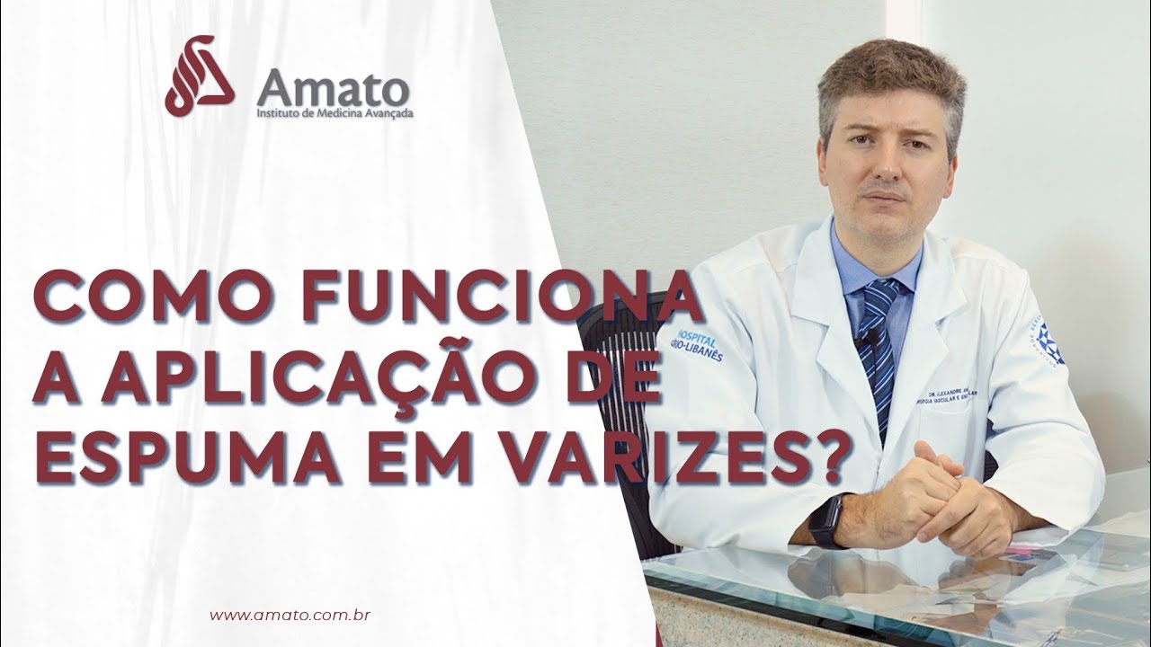Como Funciona a Aplica&ccedil;&atilde;o de Espuma em Varizes? Espuminha trata varizes?