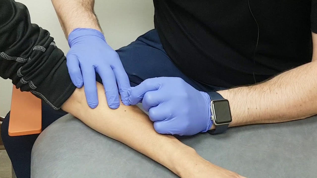 Dry Needling for Tennis Elbow