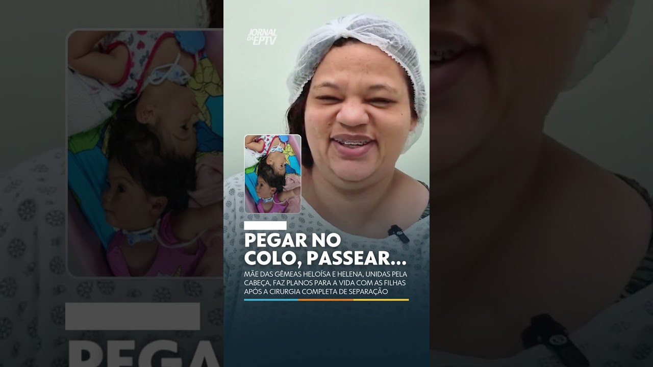 GÊMEAS SIAMESAS UNIDAS PELA CABEÇA
