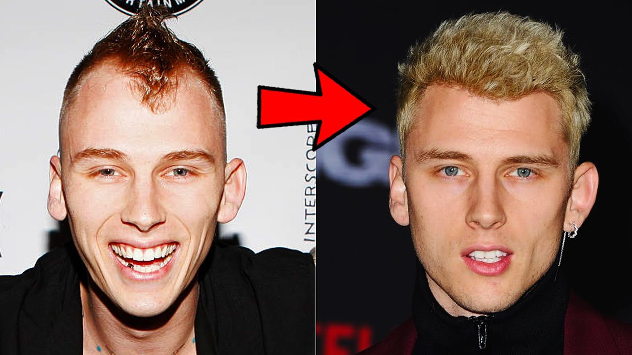 The Difference A Good Hair Transplant Can Make - Machine Gun Kelly Before And After