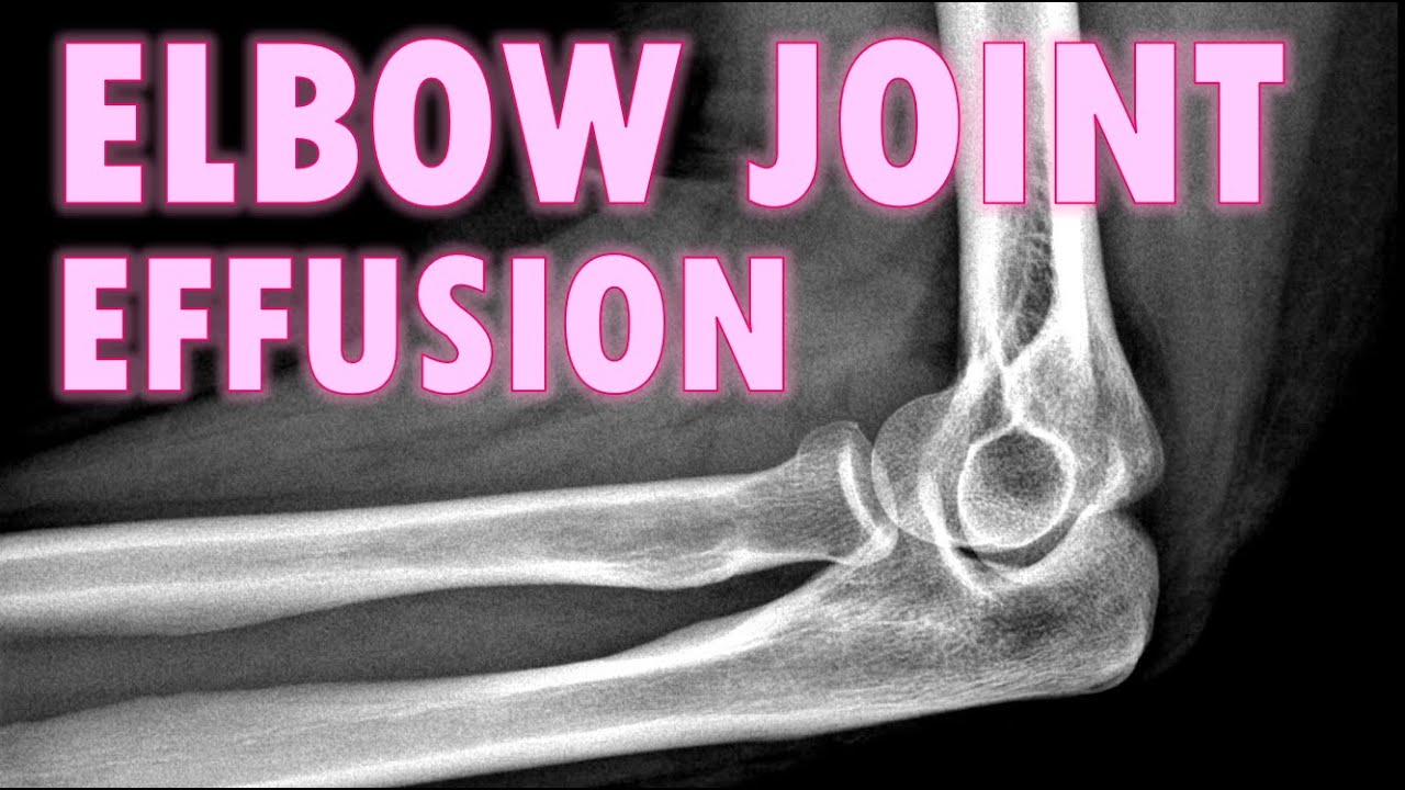 Elbow Joint Effusion - Sail Sign